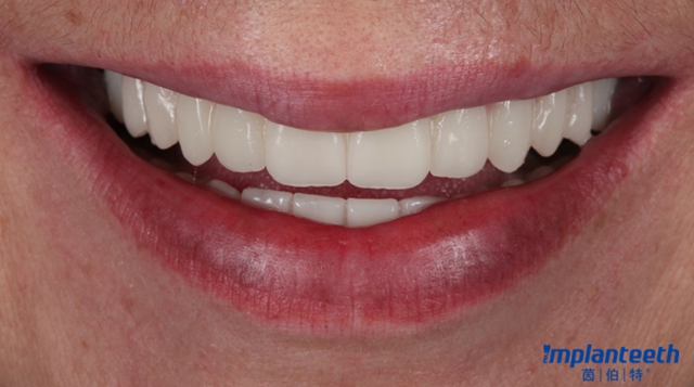 drwaelatt全口种植个性化璞睿陶氧化锆基台的应用