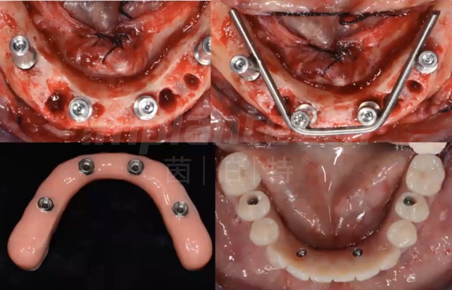 全口无牙颌数字化即种即修