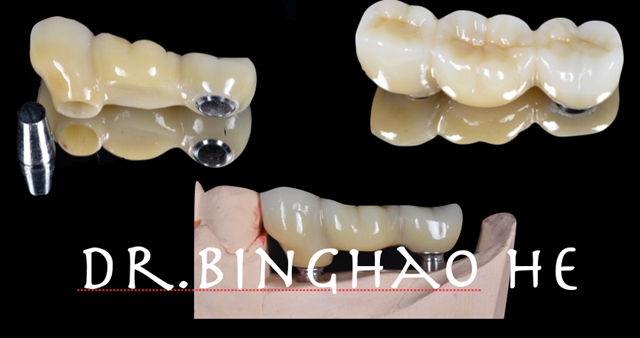 病例分享运用ankylos种植系统摩擦固位实现单冠及桥体修复