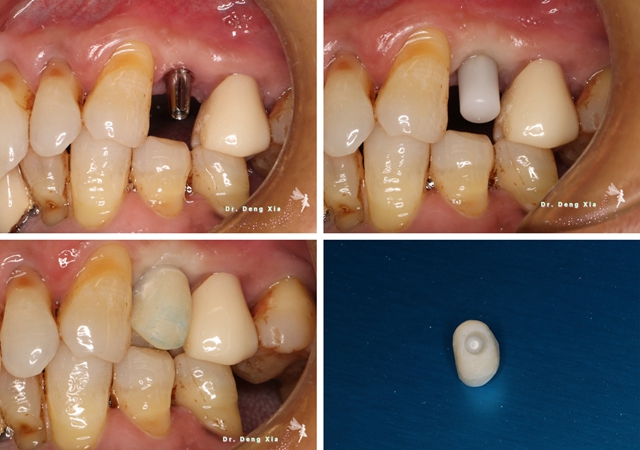 病例分享ankylos摩擦固位种植单冠修复一例