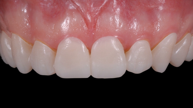 案例分享|泽康赞mock-up多功能美学咬合垫 - 茵伯特