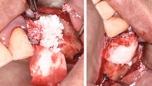 病例分享|多个后牙ankylos摩擦固位桥修复 - 茵伯特